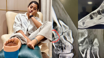 रशमिका मंडन्ना ने घायल पैर का एक्स-रे साझा किया; 'छवा' को बढ़ावा देते हुए 3 फ्रैक्चर और मांसपेशियों के आंसू का खुलासा करता है